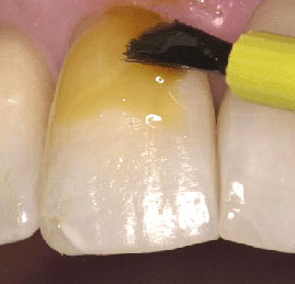 Control Odontol&oacute;gico de Ni&ntilde;o Sano